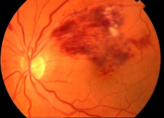 Retinal vein occlusion Eye Health Central