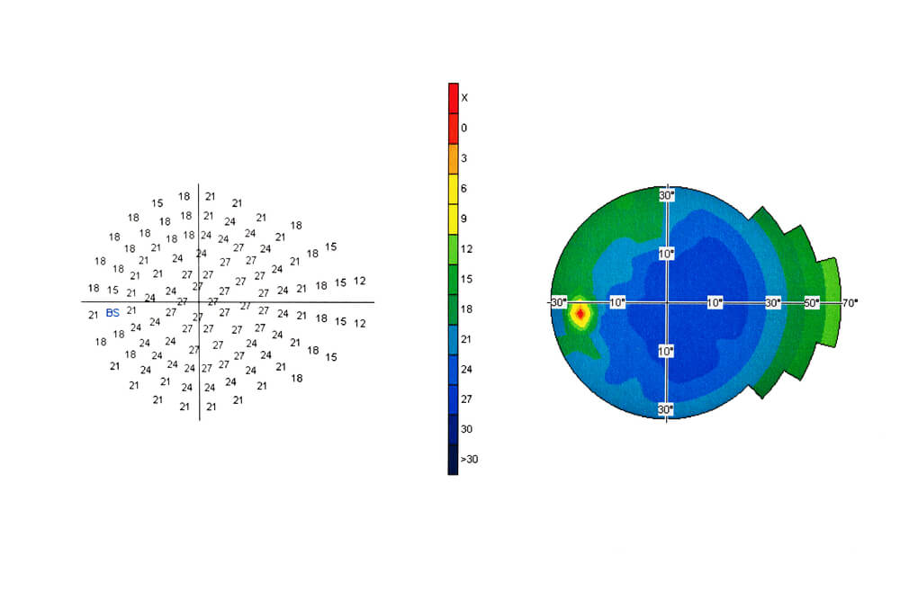 Visual Field Test read out